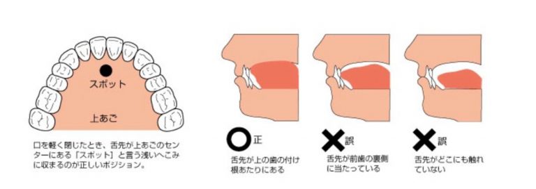 正しい舌の位置の説明図イラスト